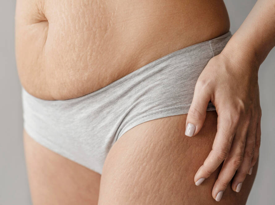 PRP Stretch Marks Treatment