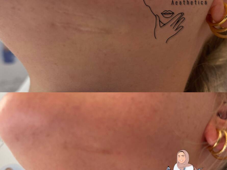 PRP Scar Marks Treatment