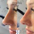Enhance Your Appearance Non-Invasively with Non-Surgical Rhinoplasty